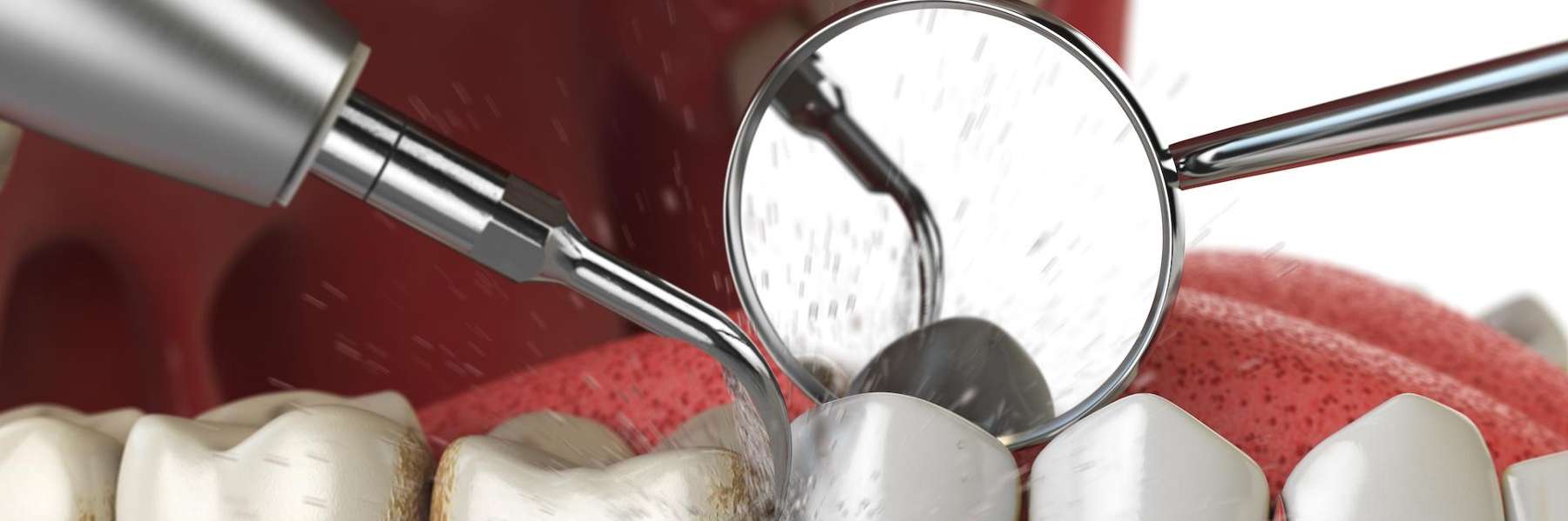 image of a teeth cleaning at the dentist in fort lauderdale