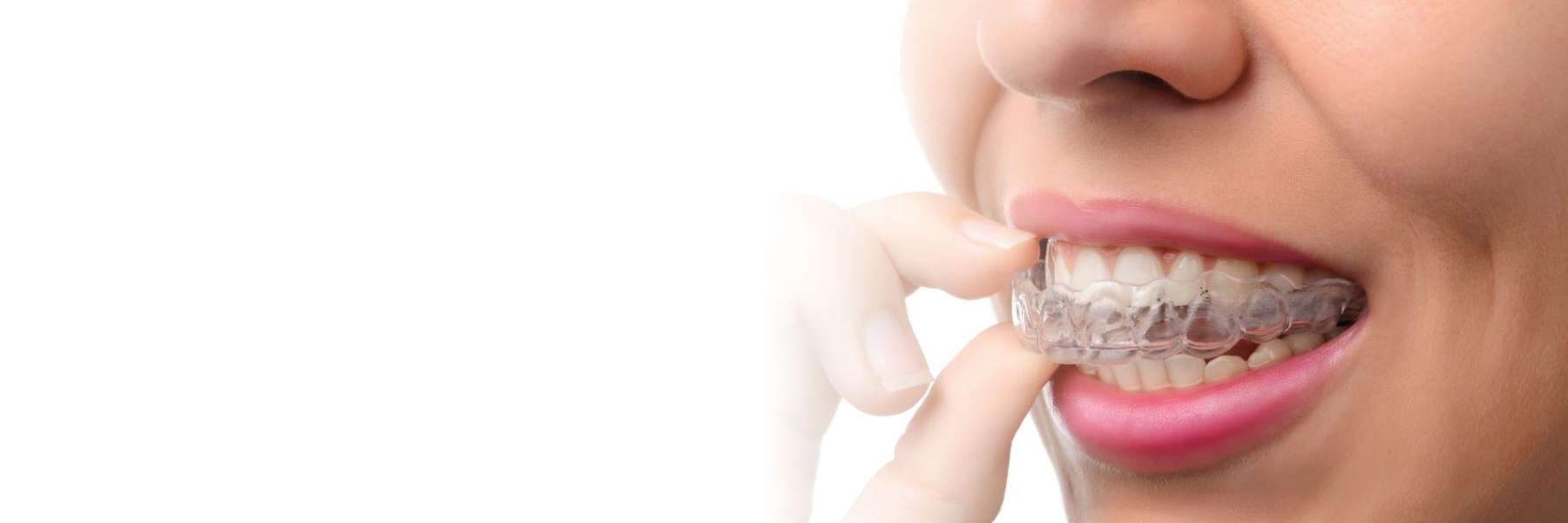 Clear Aligners | Dentist